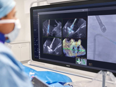 필립스, 심장 판막 수리를 안내하는 AI 도구 출시